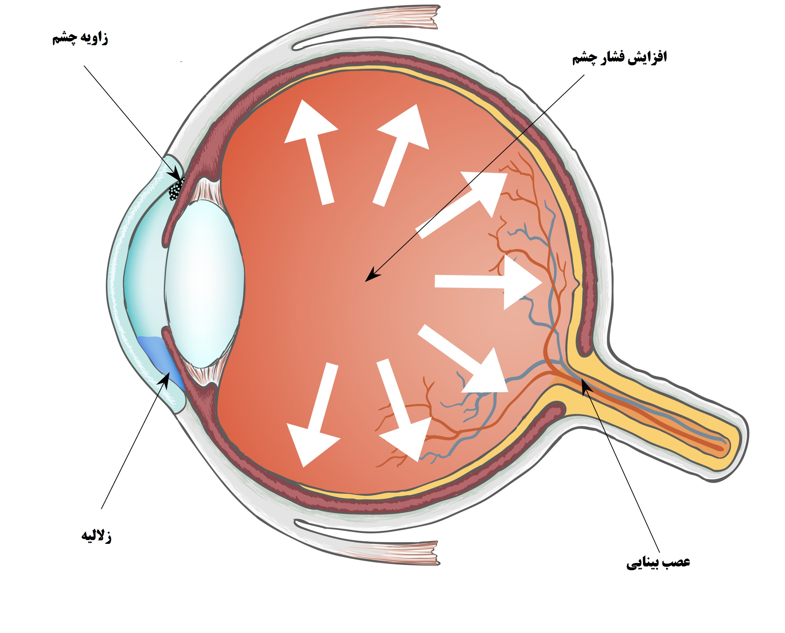الجلوکوما